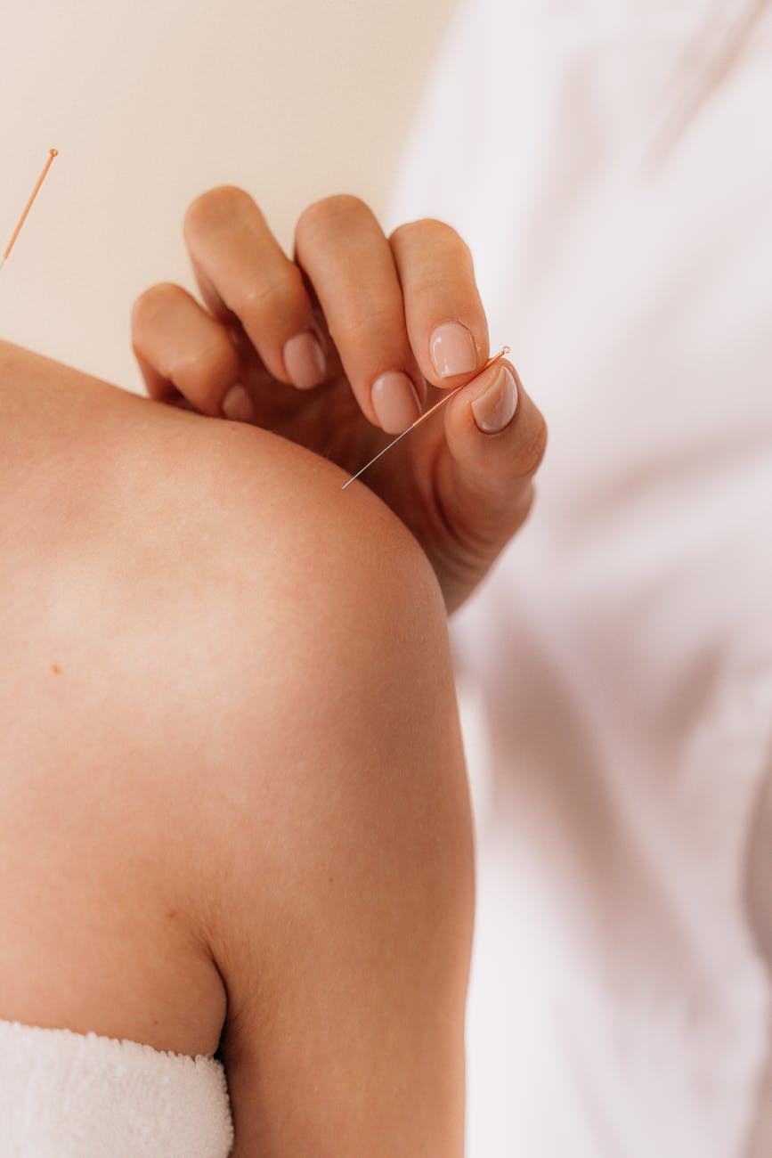 acupuncturist putting needles on the shoulder of a person